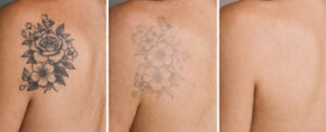 Quanto Custa Remoção de Tatuagem em Curitiba?