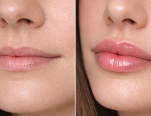 Preenchimento labial em Curitiba